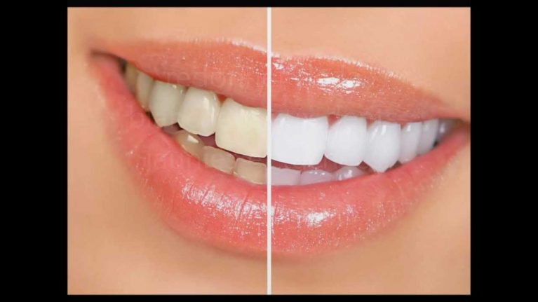 Comment avoir les dents blanches rapidement